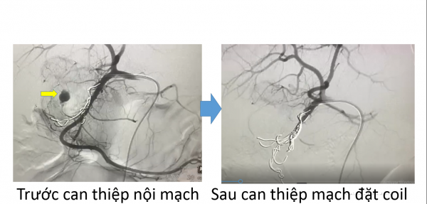 Cứu sống một trường hợp sốt xuất huyết kèm xuất huyết tiêu hóa nặng nhờ can thiệp nội mạch