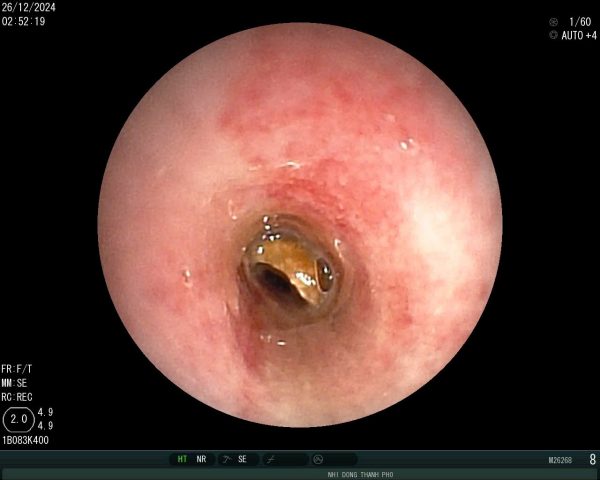 Cứu sống một trường hợp trẻ hóc dị vật đường thở là hạt đậu phộng