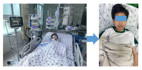 Cứu sống một trường hợp sốt xuất huyết kèm xuất huyết tiêu hóa nặng nhờ can thiệp nội mạch