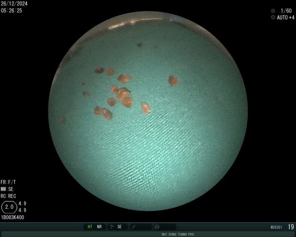 Cứu sống một trường hợp trẻ hóc dị vật đường thở là hạt đậu phộng