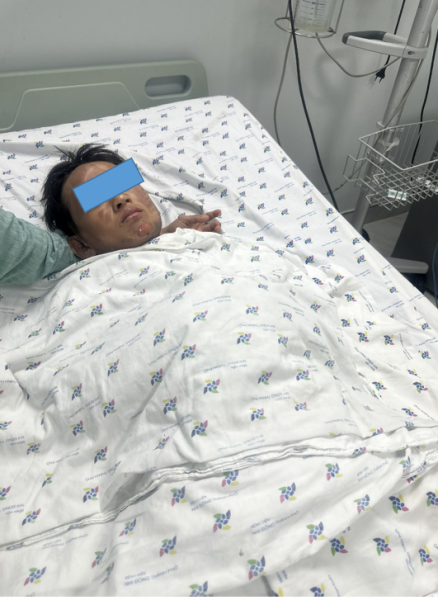 Cứu sống một trường hợp trẻ phỏng nặng do đốt cồn với lúa làm cốm nổ