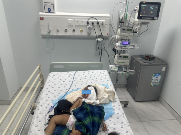 Cứu sống một trường hợp trẻ phỏng nặng do với tay làm ngả bình nước sôi