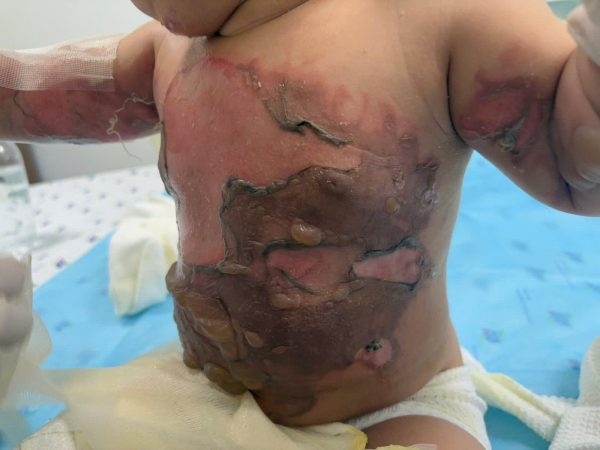 Cấp cứu một trường hợp trẻ phỏng nặng do với tay làm ngã nồi chè đang nấu sôi