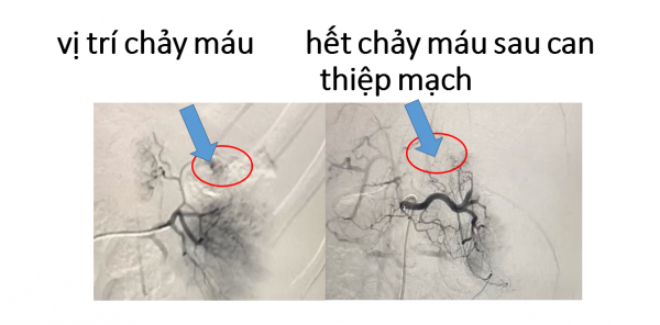 Can thiệp nội mạch cầm máu ở trẻ chấn thương vỡ lách độ IV