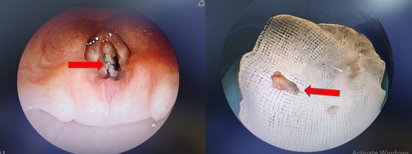 Cứu sống một trường hợp trẻ hóc dị vật đường thở là mảnh xương gà