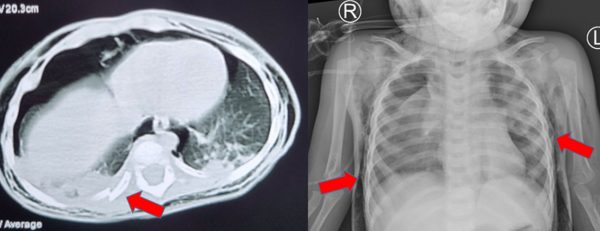 Cứu sống một trẻ chấn thương vỡ khí quản hiếm gặp