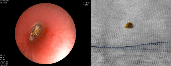 Cấp cứu một trường hợp trẻ hóc dị vật đường thở là hạt bắp ngô