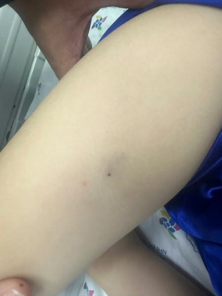 Cứu sống một trường hợp ong đốt gây sốc phản vệ