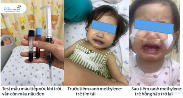 Cấp cứu kịp thời cứu sống một trẻ tím tái nặng do methemoglobine máu