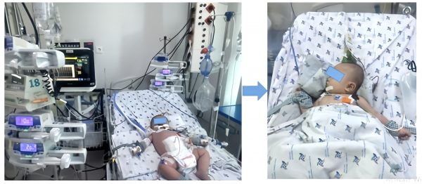 Cứu sống một trường hợp sốc sốt xuất huyết nặng ở trẻ nhũ nhi 7 tháng tuổi, suy hô hấp nặng, rối loạn đông máu nặng