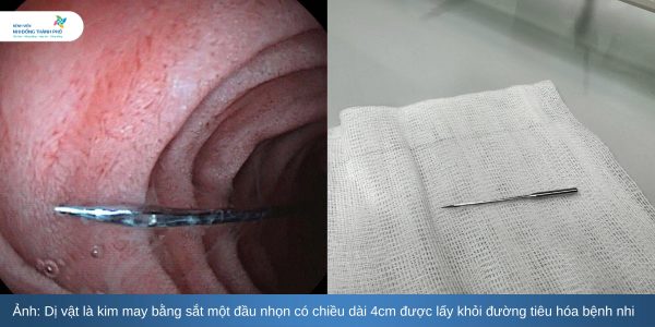 Bé 11 tuổi nuốt kim may, suýt mất mạng vì tai nạn bất ngờ