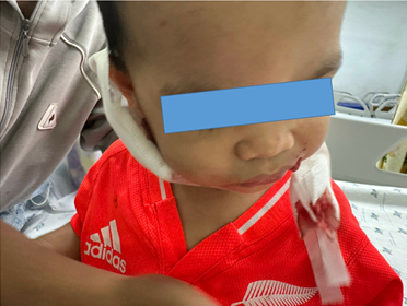 Cấp cứu một trường hợp chó cắn