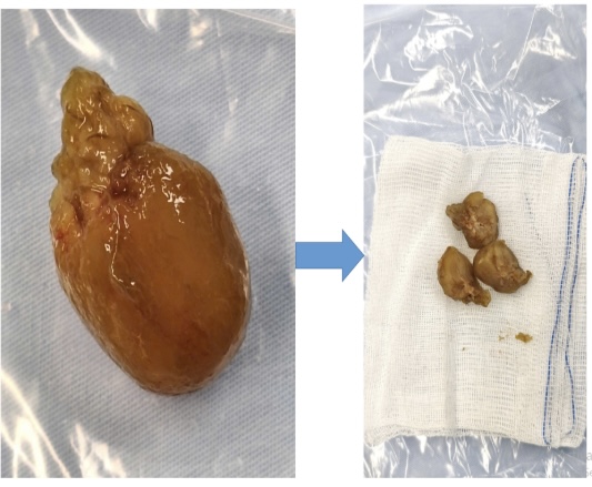 Cấp cứu một trường hợp trẻ bị tắc ruột do quả cóc