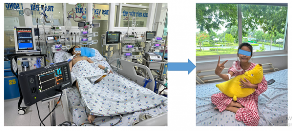 Cứu sống một trẻ viêm cơ tim tối cấp, sốc nhiễm trùng, nhiễm trùng huyết do phế cầu nhờ kỹ thuật oxy hóa máu qua màng ngoài cơ thể (ECMO)