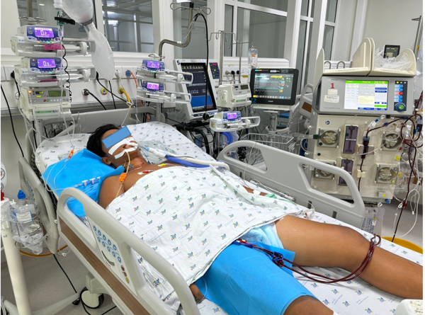 Cứu sống một trường hợp sốc nhiệt nặng biến chứng hủy cơ, suy đa cơ quan